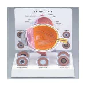 Anatomical Chart Company   Cataract Eye Model  Industrial 